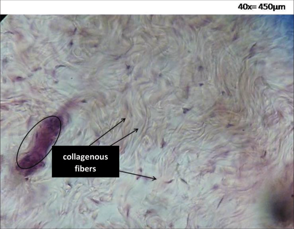 Photomicrograph hematoxylin and eosin-stained histological section of skin (×40) representative of the dense connective tissue observed detailing the thickness and organization of the collagen fibers. The circle indicates the point from where the cannula should be accessed. From the same opening hole in the skin you can enter in several directions as indicated by the 3 oblique black arrows.