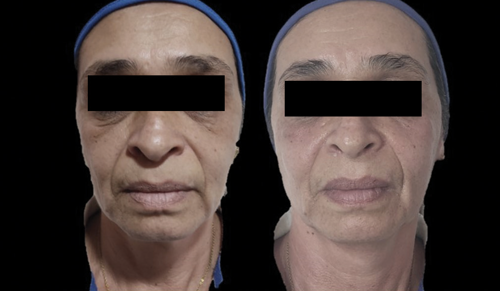 Case 1. Facial firming was obtained with the Cartesian Technique™ and smart polydioxanone suture (Smart PDOs™).