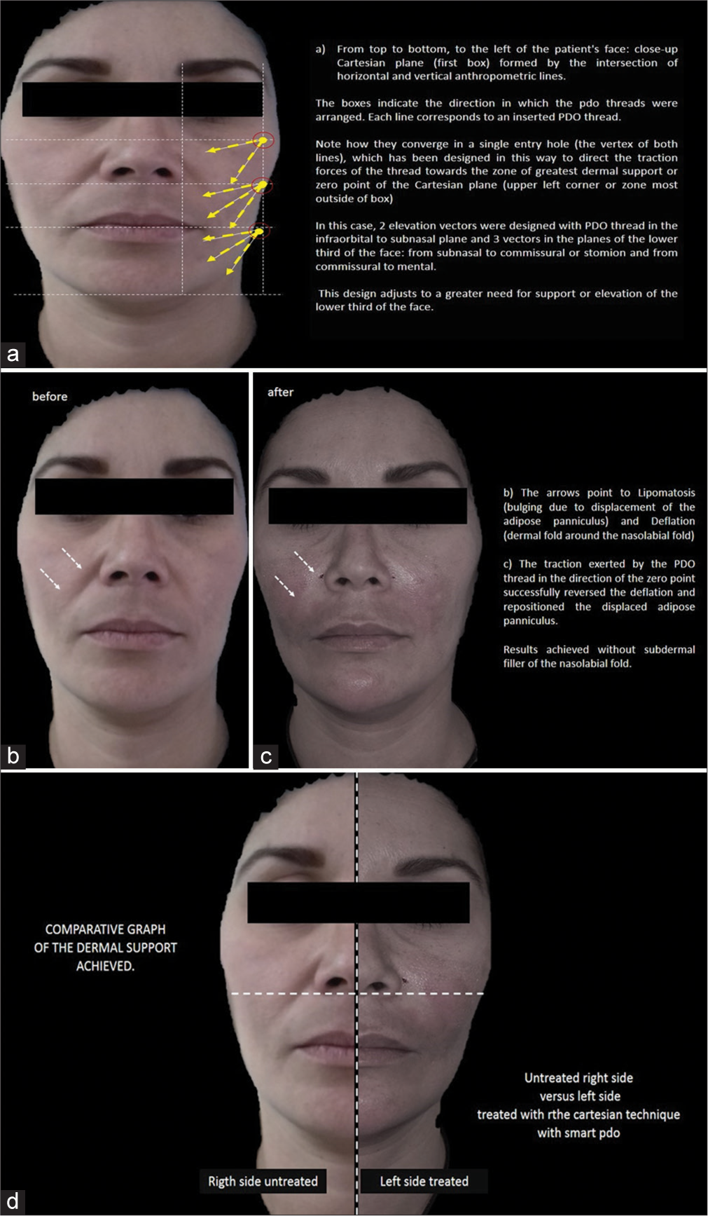 Case 2 - (a) Diagram of design of the Cartesian Technique™ and smart polydioxanone suture (Smart PDOs™) over the patient. The yellow arrows indicate the direction of the Polydioxanone (PDO) thread (vector). As indicated by the 2 yellow arrows, 2 PDO sutures were inserted between the infraorbital and subnasal plane. Between the infraorbital and subnasal plane, 3 vectors or threads were inserted (yellow arrows) and 3 vectors (in the direction of the yellow arrows) or 3 threads were inserted between the planes of the lower third of the face: from subnasal to commissural or stomion and from commissural to mental. (b) Before and (c) after. (d) Results of the Cartesian Technique™ and Smart PDOs™.