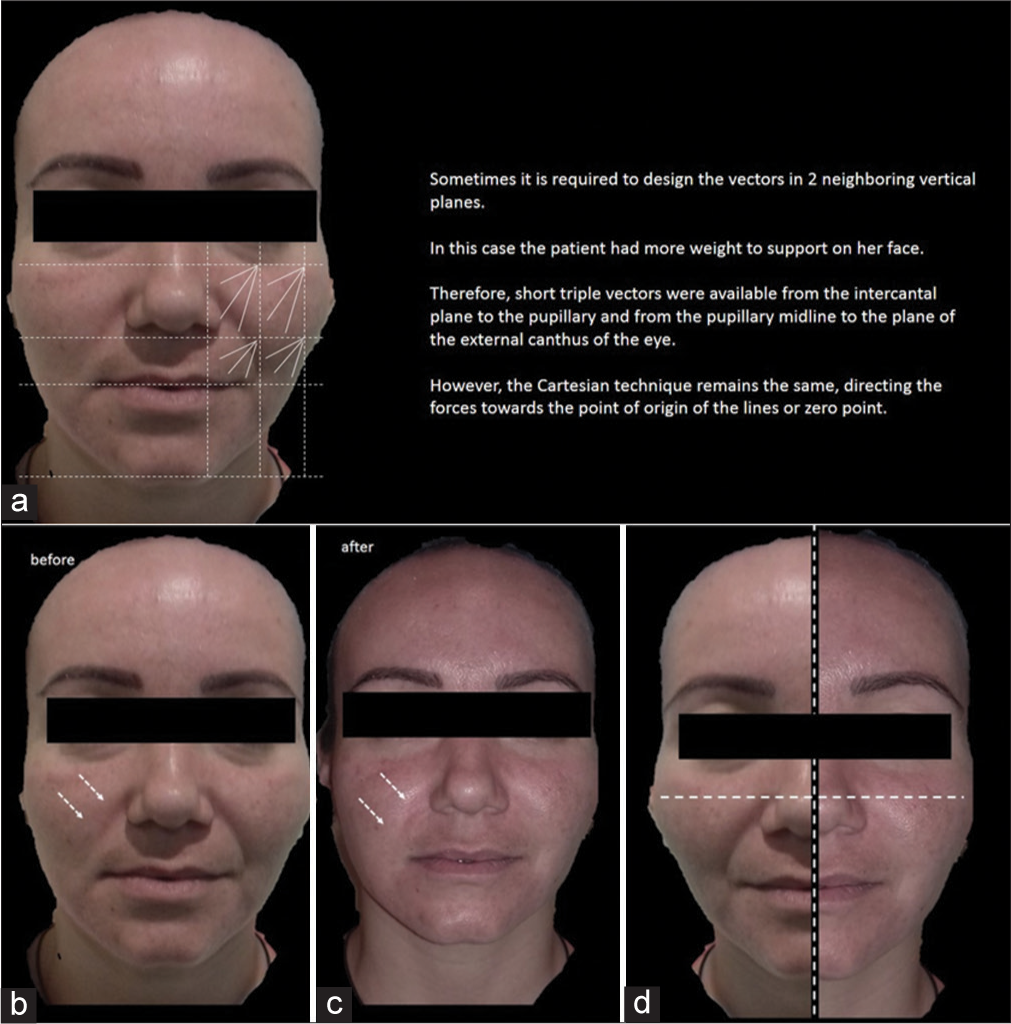 Case 3 – (a) Diagram of design of the Cartesian Technique™ and smart polydioxanone suture (Smart PDOs™) over the patient. (b) Before and (c) after. The white arrows in (a), (b), and (c) indicate how by elevating the most superior and external tissues of the face with this system, the nasolabial fold, nasojugal fold, mentolabial folds, and primary and secondary wrinkles are reversed. The Jowls is also softened, demarcating the mandibular contour. (d) Results of the Cartesian Technique™ and Smart PDOs™. The horizontal and vertical dotted line represents the transverse plane of the face or X axis and the Y axis of the face. The dotted dividing line shows the untreated sagging tissues on the left side of the face, whereas, the tissues on the right side of the face (treated with the Cartesian technique and Smart PDOs) are observed to be much higher.