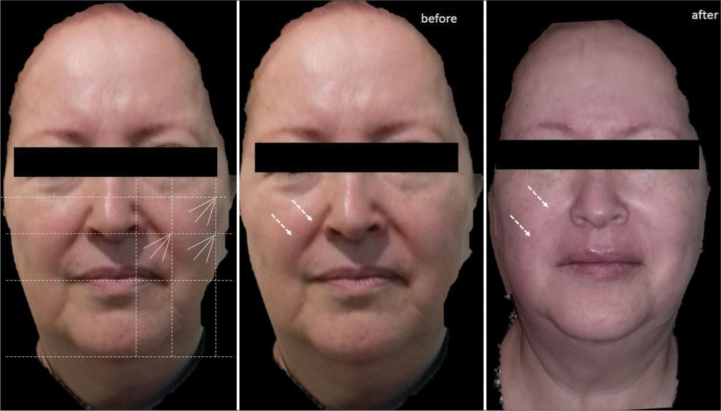 Case 4: Diagram of design of the Cartesian Technique™ and smart polydioxanone suture (Smart PDOs™) over the patient and its results. The white arrows indicate how by elevating the most superior and external tissues of the face with this system, the nasolabial fold, nasojugal fold, mentolabial folds, and primary and secondary wrinkles are reversed. The Jowls are also softened, demarcating the mandibular contour.