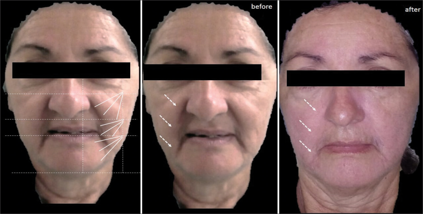 Case 5: Diagram of design of the Cartesian Technique™ and smart polydioxanone suture (Smart PDOs™) and its results. The white arrows indicate how by elevating the most superior and external tissues of the face with this system, grooves such as the nasolabial groove are reversed.