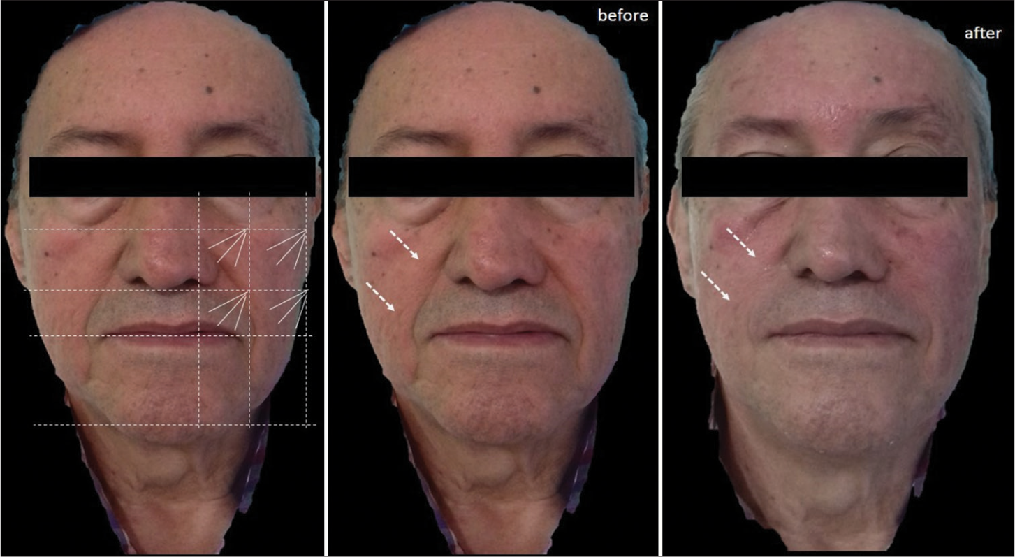 Case 6: Diagram of design of the Cartesian Technique™ and smart polydioxanone suture (Smart PDOs™) and its results. The white arrows indicate how by elevating the most superior and external tissues of the face with this system, furrows such as the nasolabial groove are reversed.