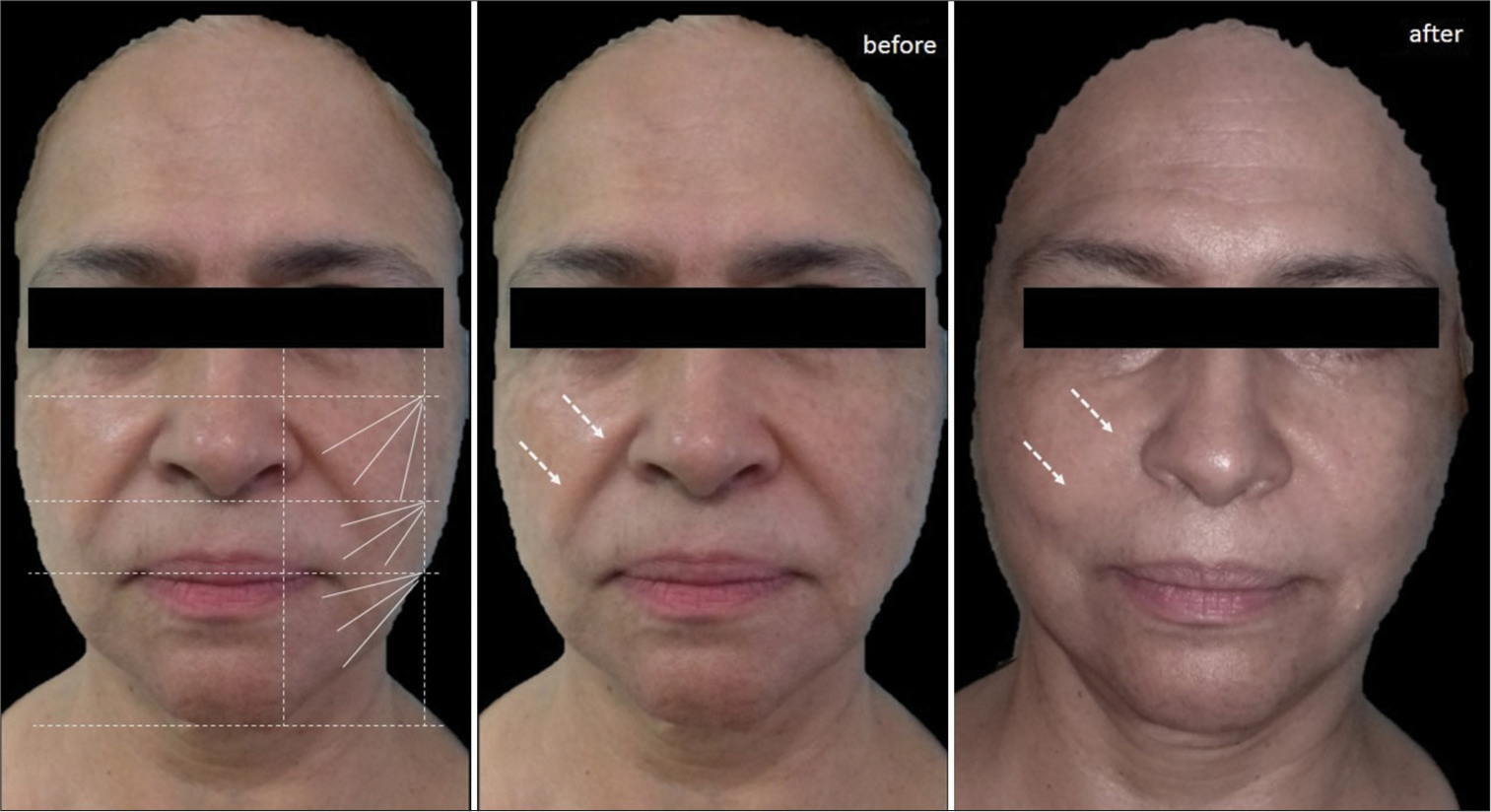 Case 7: Diagram of design of the Cartesian Technique™ and smart polydioxanone suture (Smart PDOs™) and its results. The white arrows indicate how by elevating the most superior and external tissues of the face with this system, furrows such as the nasolabial groove are reversed.