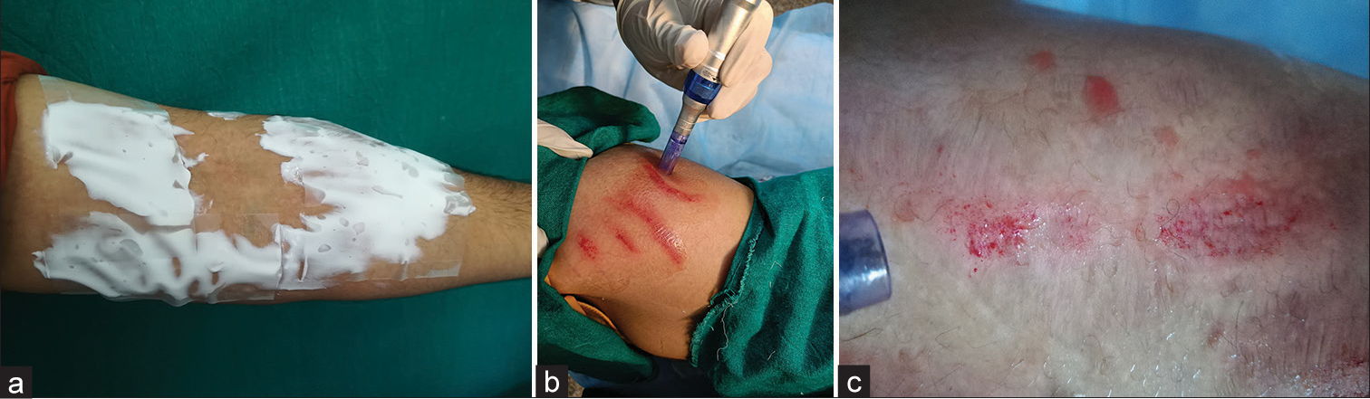 Steps of procedure (a) EMLA cream was applied on the treatment area 40–45 min before the procedure. (b) Area cleaned with antiseptic solution and microneedling was done on stretch marks (or scar marks) using hand held Dermapen and disposable cartridges. In patients allocated to Group B, autologous platelet-rich plasma was additionally used topically during the procedure. (c) Pin-point bleeding points were considered as the end of the treatment.