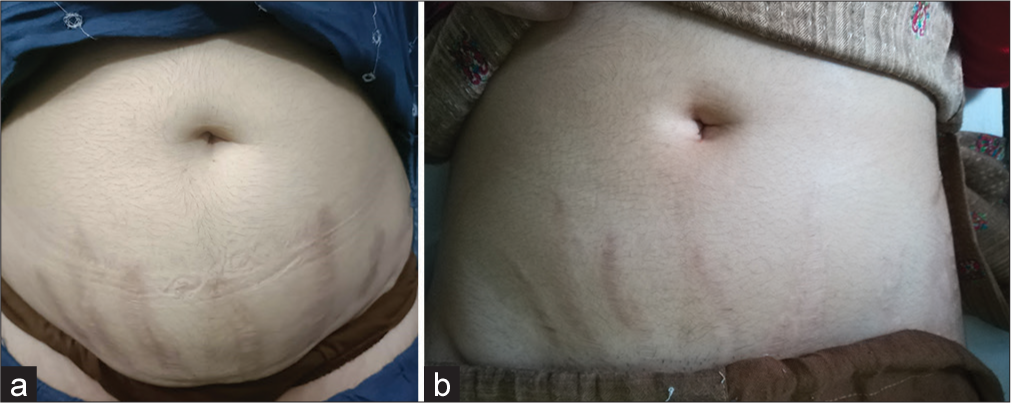 (a) A 24-year-old female allotted to Group A (Microneedling alone). Clinical appearance of stretch marks over abdomen at the start of the study. (b) Clinical appearance of stretch marks present over abdomen at end of study (20 weeks).