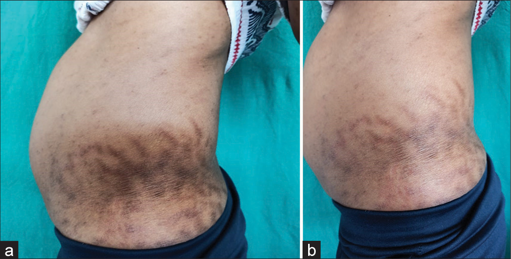 (a) A 28-year-old male allotted to Group B (Microneedling with autologous platelet rich plasma). Clinical appearance of stretch marks over lateral abdomen at the start of the study. (b) Clinical appearance of stretch marks present over lateral abdomen at end of study (20 weeks).