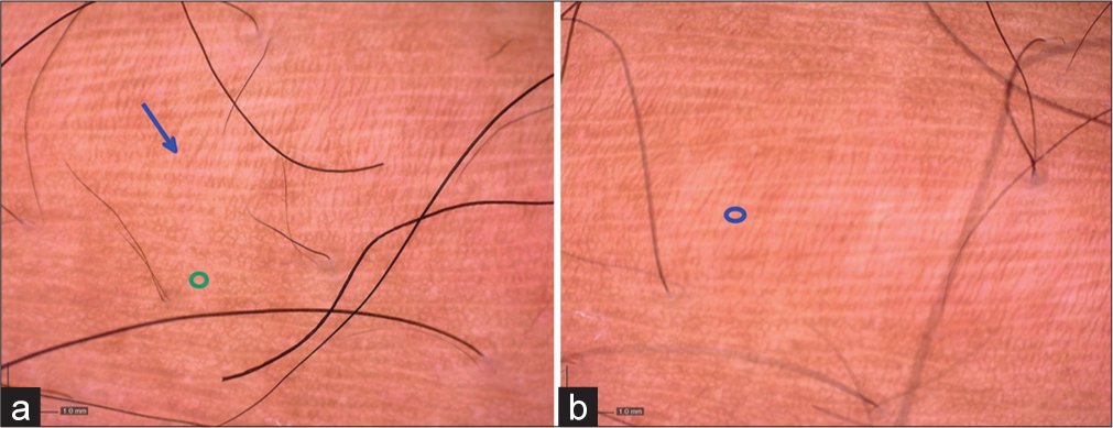 (a) Dermoscopy findings (magnification: ×35) of the stretch marks at the start of the study showing atrophic skin (blue arrow) with normal adjacent skin (green circle). (b) Dermoscopy findings (magnification: ×35) of the stretch marks at the end of study (20 weeks) show decrease in atrophy and pigmentation (blue circle).