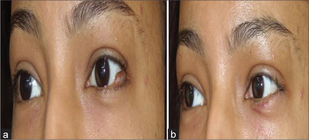 (a) Large melanocytic nevi pre-procedure and (b) 1 week post-procedure.