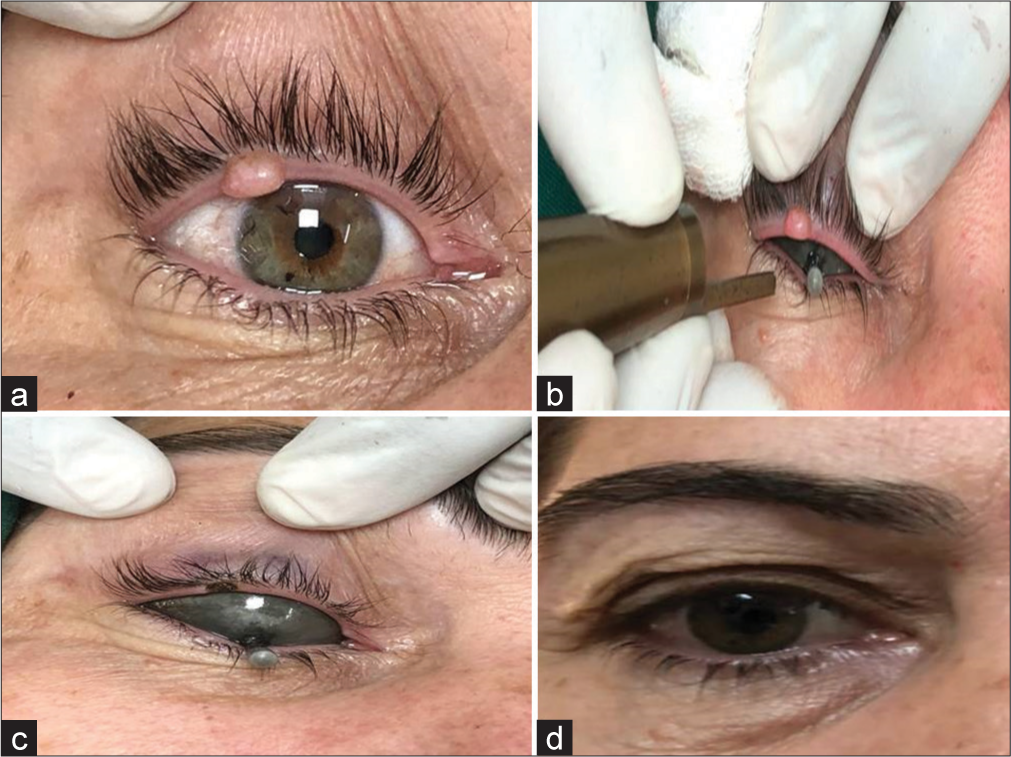 (a) Cystic hidradenoma on upper eyelid pre-procedure, (b) during the procedure, (c) immediately post-procedure, and (d) 4 weeks after the procedure.