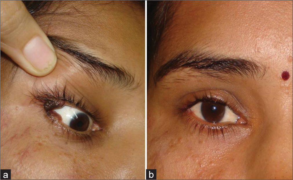 (a) Large melanocytic nevus of the upper and lower eyelids affecting the lateral canthus of the right eye and (b) 4 weeks after the procedure.