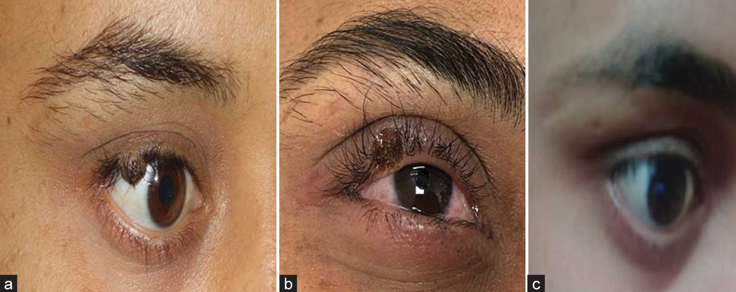 (a) Medium melanocytic nevi, (b) immediate post-procedure, and (c) 4 weeks later.