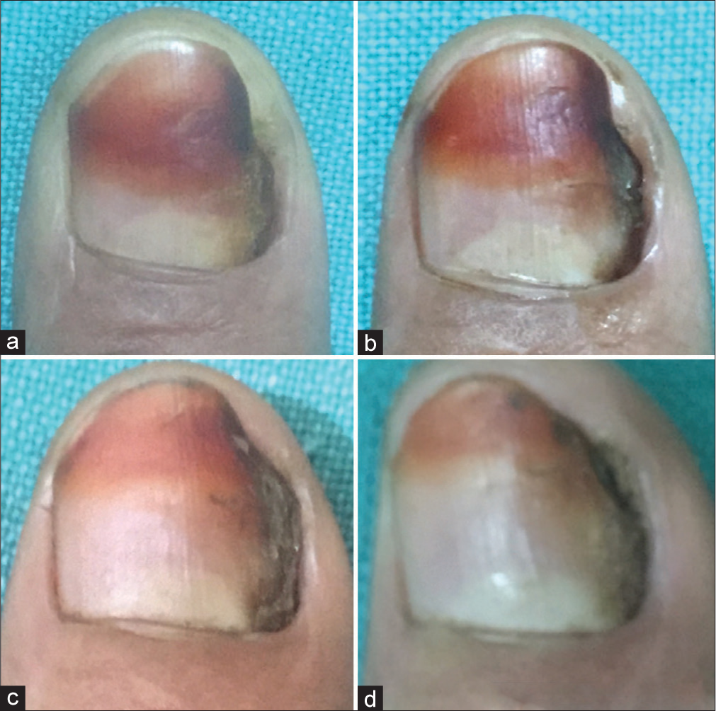 (a-d) The dystrophic lateral nail plate is replaced with a healthy nail plate about 4 month later.