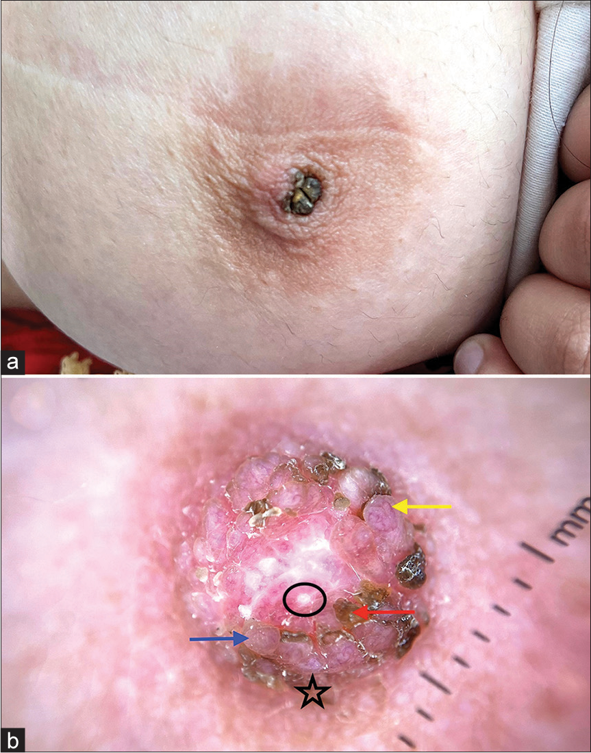 (a) Hyperkeratotic, papillated projections few with overlying adherent brownish to hyperpigmented crust. (b) Dermoscopic examination showing multiple papillated growths (blue arrow) having overlying curved vessels and linear vessels with branches (yellow arrow), white clods (in a circle). Yellow-brown scales and crust (red arrow) along with a peripheral brown pigmentation (black star) was also appreciated.