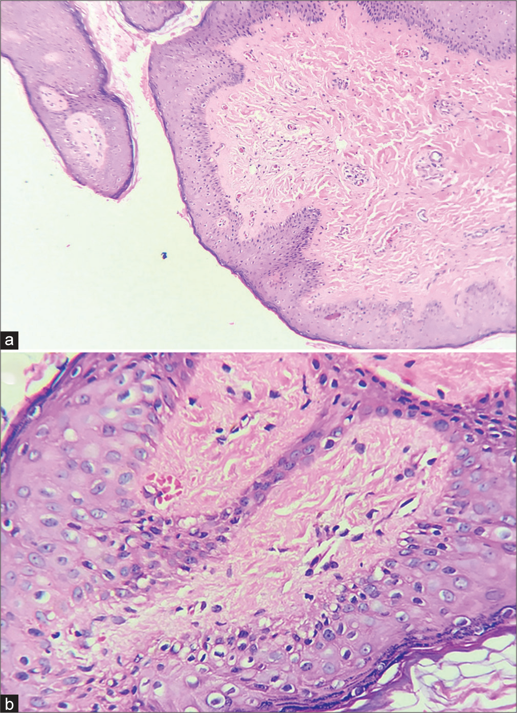 (a) Histopathological examination showed epidermal acanthosis, keratin plugging, papillomatosis, anastomosis of rete ridges along with dilatation of vessels and fibrosis present in the dermis (H&E, 10×). (b) Presence of anastomosis of rete ridges and dilation of dermal vasculature appreciated better in higher power (H&E, 40×). H&E: Hematoxylin and eosin.