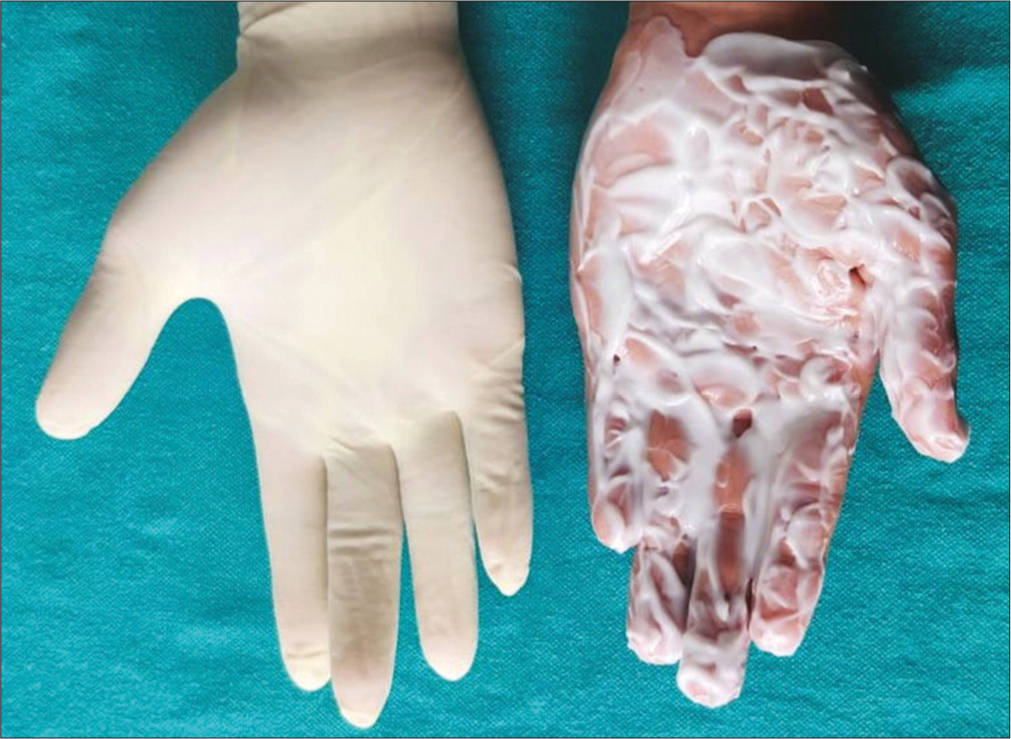 Application of thick layer of lignocaine-prilocaine mixture followed by occlusion by double surgical gloves for two sessions of 1 hour each.