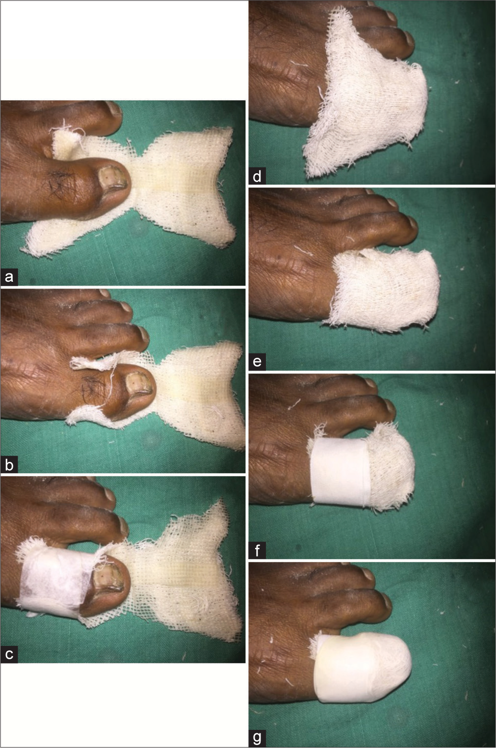 (a-g) The dumbbell shape of two-layered bandage; the ventral part of the bandage is wrapped and (a-c) stabilized first on the toe and (d-g) then the dorsal part on the toe with the nail unit.