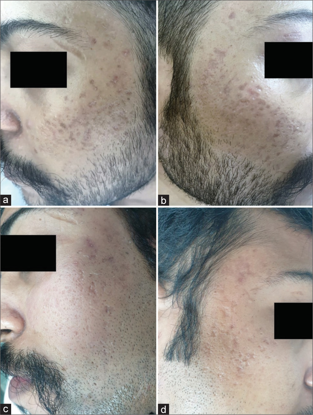 (a) and (b) Multiple postacne atrophic scars on both sides of the face. (c) and (d) Significant improvement on both sides of the face following microneedling with topical insulin (left side) and platelet-rich plasma (right side).