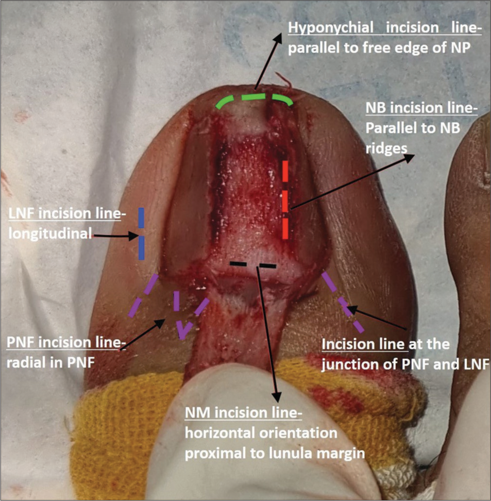 Nail unit incision lines (NUIL) during nail surgery (represented as broken lines), to be followed in various anatomic areas of the nail unit. Nail bed (NB) incision line (red), nail matrix (NM) incision line (black), proximal nail fold incision (PNF) lines (purple), lateral nail fold (LNF) incision line (blue), and hyponychial incision line (green) are depicted. NP: Nail plate.