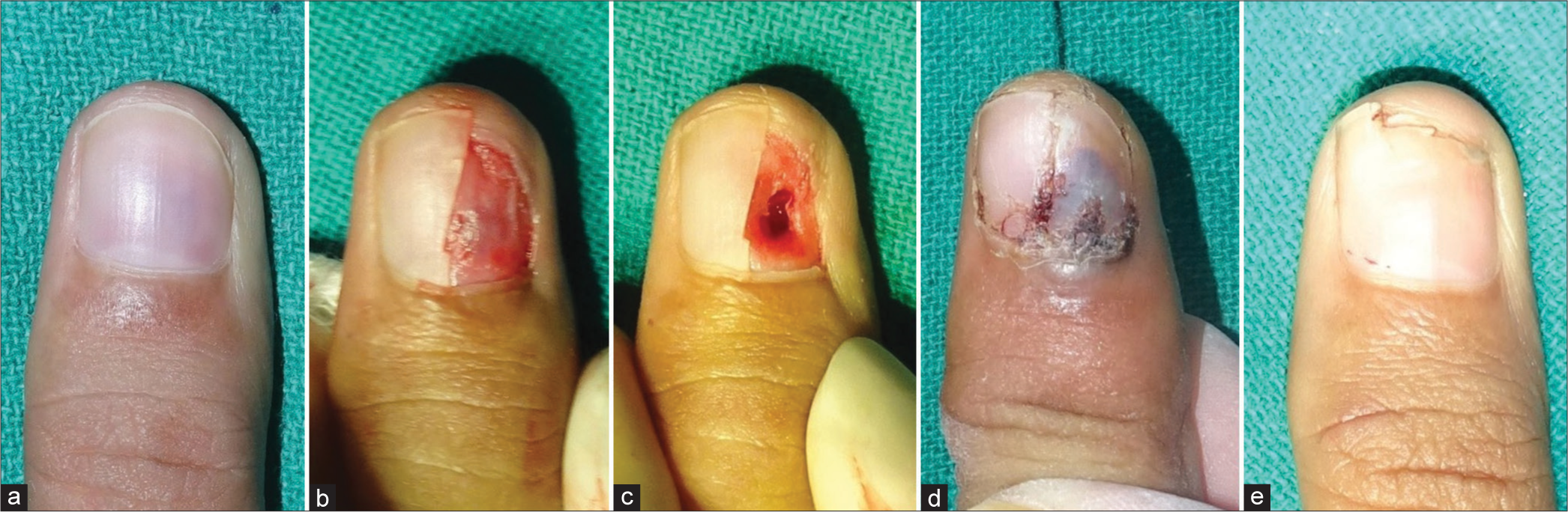 (a-e) Longitudinal nail bed incision to remove a glomus tumor in this location. (a) Nail bed glomus tumor is seen as a bluish discoloration through the nail plate. (b) Lateral partial nail avulsion to expose the nail bed tumor. (c) Longitudinal excision of the tumor with the resultant nail bed defect. (d) Primary closure with nail plate repositioning, as seen at one week. (e) Regrowth of normal nail plate 5 months postoperatively.