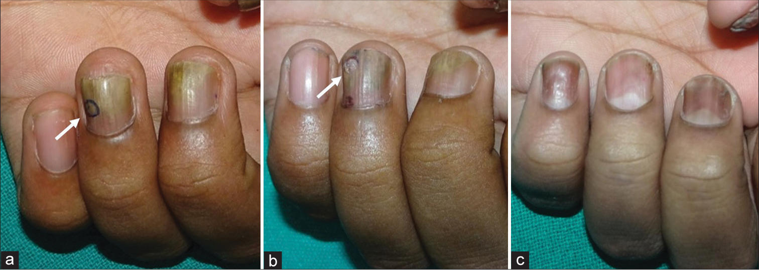 (a-c) Nail bed punch biopsy. (a) Patient with suspected nail psoriasis. The chosen biopsy site has been marked (white arrow). (b) Growing out nail plate at 2 months after a 3 mm punch biopsy (which was not sutured) (white arrow). (c) Normal appearance of the nail at 4 months (patient is on treatment for nail psoriasis) with growing out of the biopsy created defects.