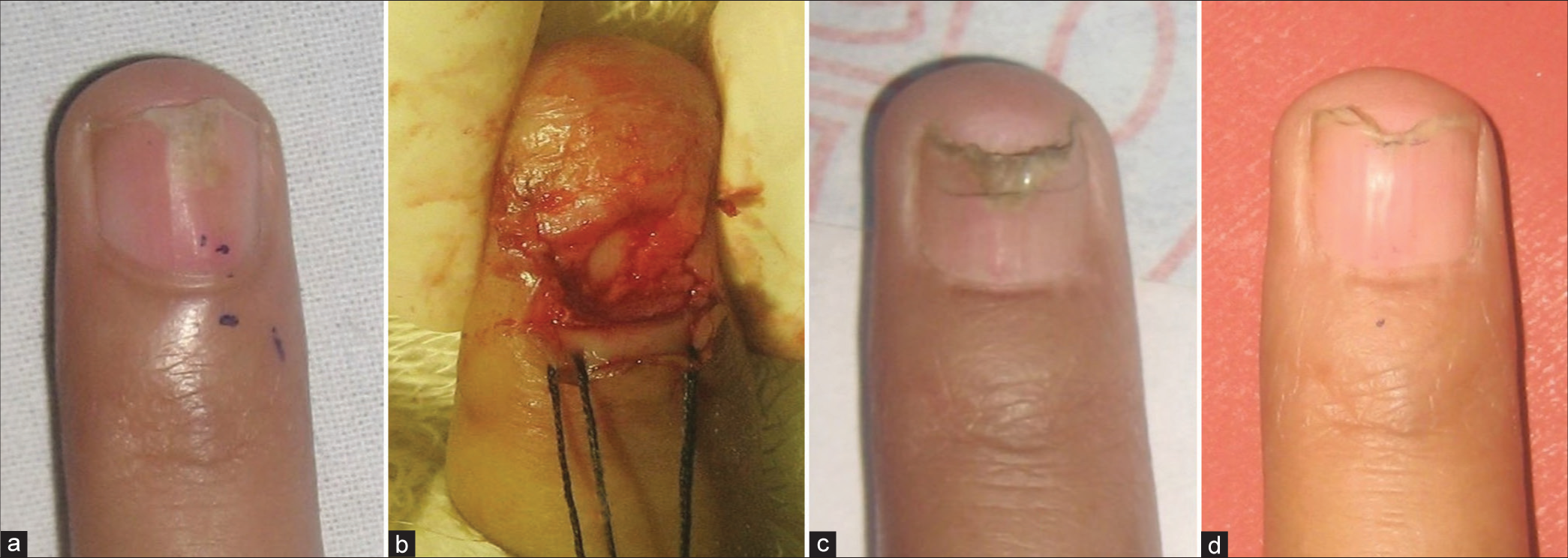 (a-d) Horizontal nail matrix incision to remove a nail matrix glomus tumor. (a) Nail matrix glomus tumor with a distal onycholysis. (b) Nail plate avulsion with retraction of the proximal nail fold (held back by stay sutures) to expose the nail matrix tumor, which has been excised. (c) Regrowth of the normal nail plate at 3 months. The laterally placed nail fold incisions have also healed without substantial scarring. (d) Normal appearing nail, without onycholysis or median split, at 5 months.