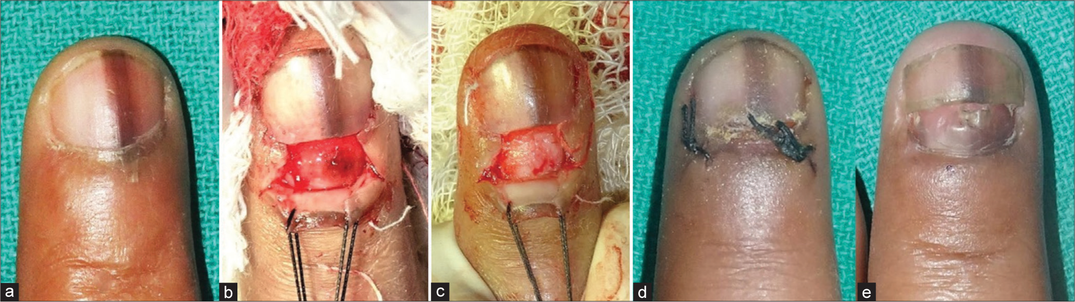 Tangential biopsy of the nail matrix for longitudinal melanonychia. (a) Longitudinal melanonychia involving the index finger. (b) Proximal partial avulsion with retraction of the proximal nail fold to expose the origin of the pigmented band. (c) Tangential shave excision was done to remove the nail matrix lesion. (d) Replacement and suturing of the proximal nail fold. (e) Regrowth of nail at 2 months. Note: The laterally placed nail fold incisions have also healed without scarring.