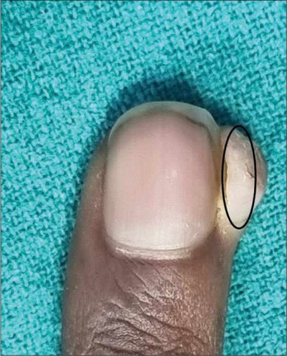 Lateral nail fold tumor (black circle) requires a longitudinal incision for complete surgical removal.