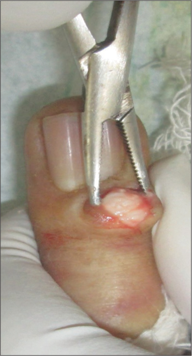 Radial incision in the proximal nail fold to expose the underlying tumor.