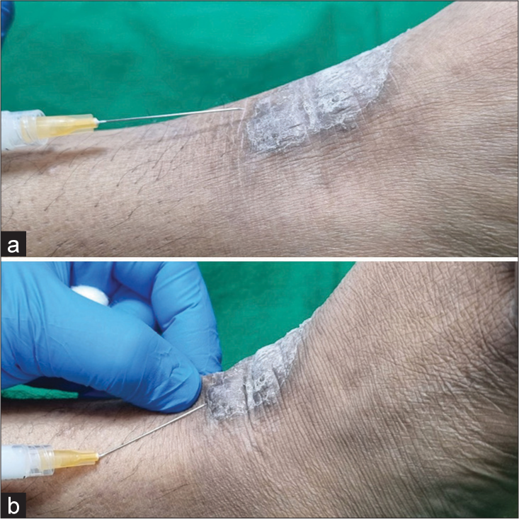 (a) Difficult navigation for intralesional injection for a chronic lichenified lesion over a curved ankle surface with a straight needle. (b) Ergonomic ease for intralesional drug delivery with a bent needle for the same lesion.