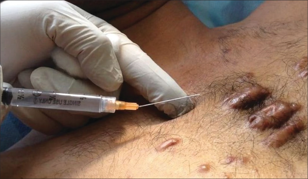 Presternal keloid injected with a bent needle (note the parallel orientation of the needle with the skin surface and lifted up a syringe).