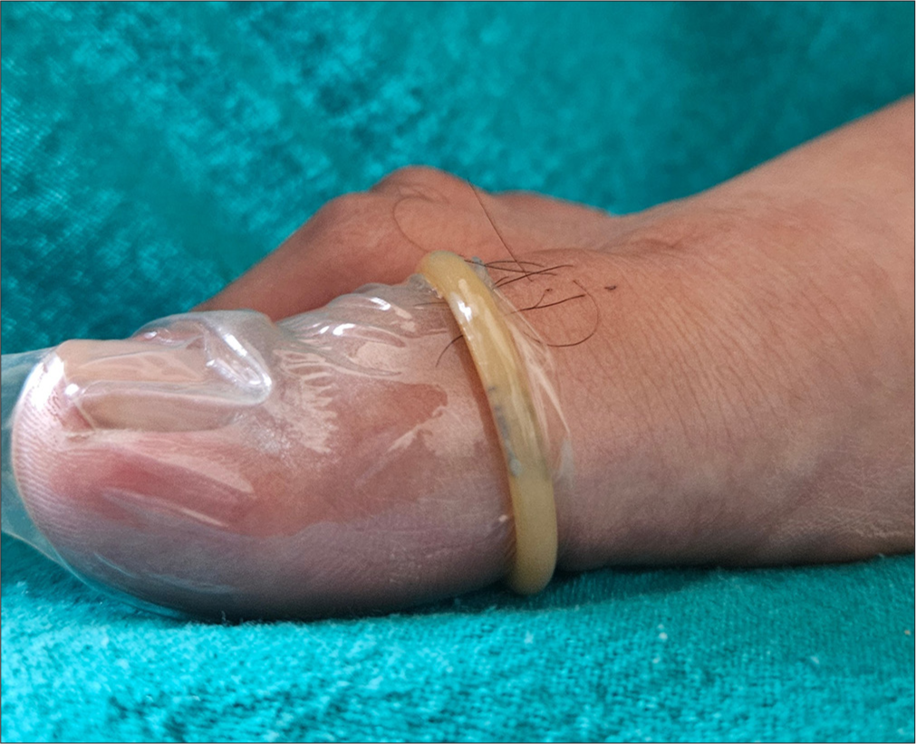 Condom worn over the big toe.