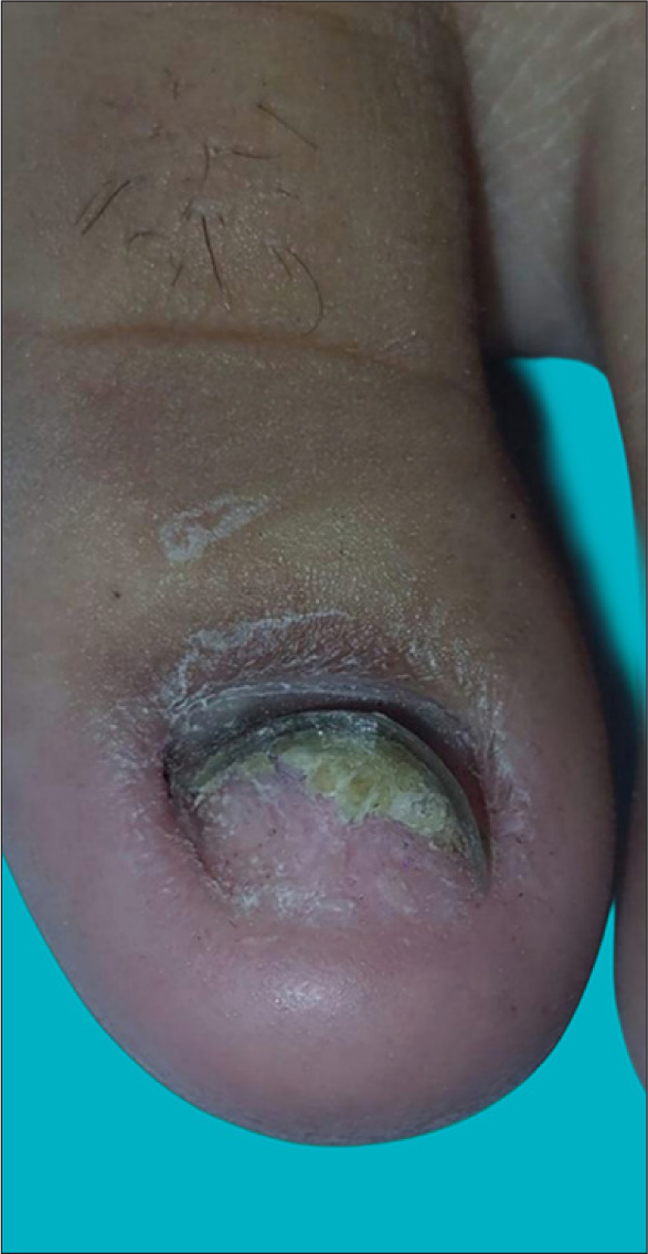 Complete clearance of lesion after topical application of wart paint and occlusion with Condom.