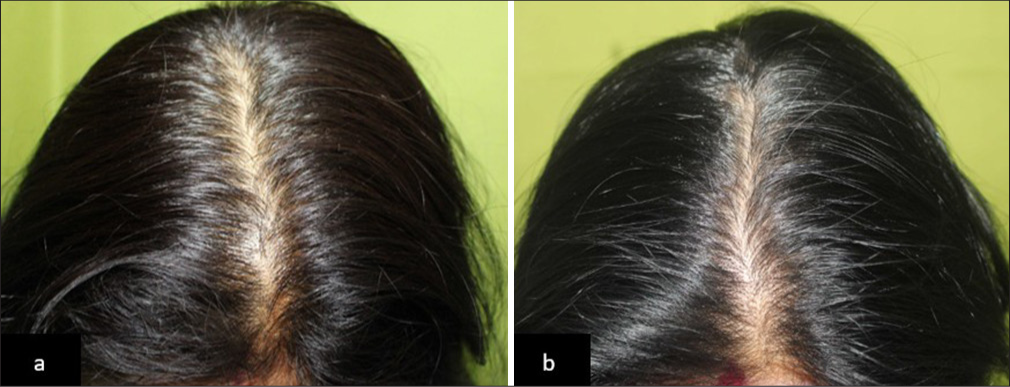 (a) Global photographs of a patient with Telogen effluvium at baseline and (b) after 90 days of hair serum treatment in Group 1.