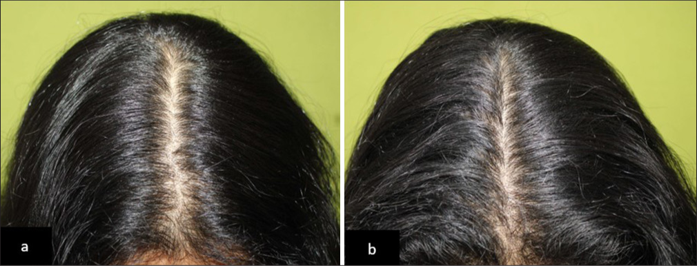 (a) Baseline global photography of a patient with Telogen effluvium and (b) noticeable improvement in hair density after 90 days of hair serum treatment in Group 2.