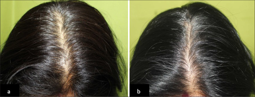 (a) Global photographs of a patient with Telogen effluvium at baseline and (b) after 90 days of hair serum treatment, showing improved hair density in Group 3.