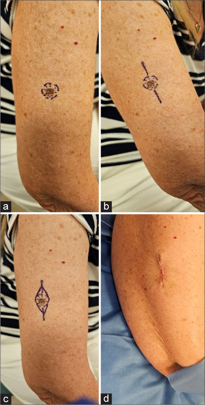 (a) Skin lesion marked, (b) marking the lesion to make a longitudinal orientation drawing maximum laxity, (c) excision margins marked with edges touching the ellipse, (d) post-excision of lesion – longitudinally oriented scar.