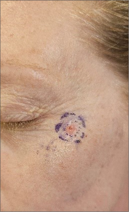 Skin lesion marked with edges making a circle.