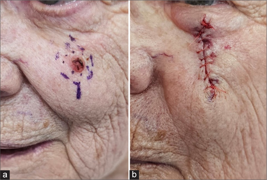 Skin lesion marked, (b) post-excision of skin lesion – vertically oriented surgical wound.
