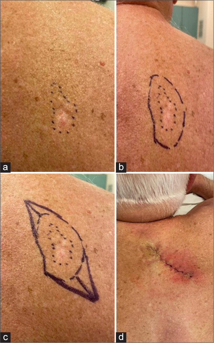 (a) Edges of skin lesion marked, (b) marking with adequate excision margin, (c) making an ellipse in the direction of resting skin tension line, (d) post-excision of lesion