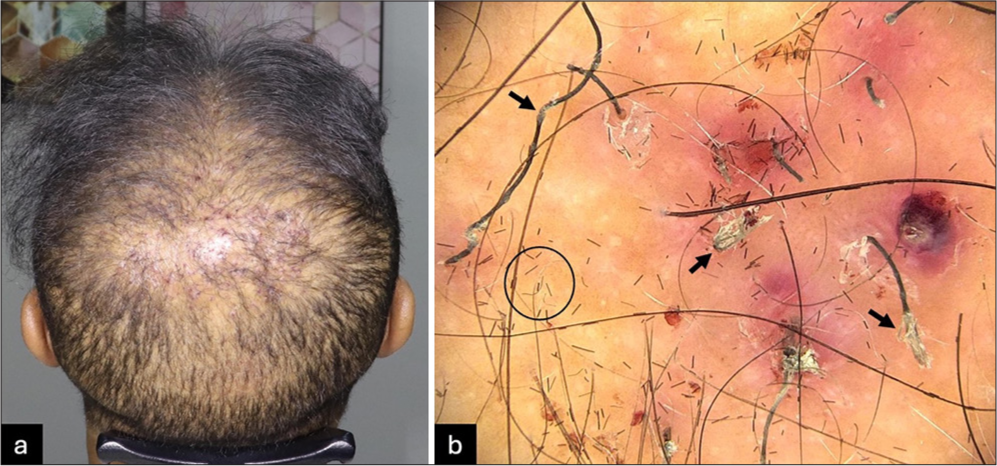 (a) Clinical presentation at the first visit showing erythema and crusting around the implanted shafts in the vertex region. (b) Dermoscopy reveals erythema and scaling surrounding implanted fibers, which appear fractured and damaged at multiple points (black arrows). The fine linear black structures in the background (circle) represent artifacts caused by the application of topical keratin fibers on the previous day (×70, FotoFinder system).