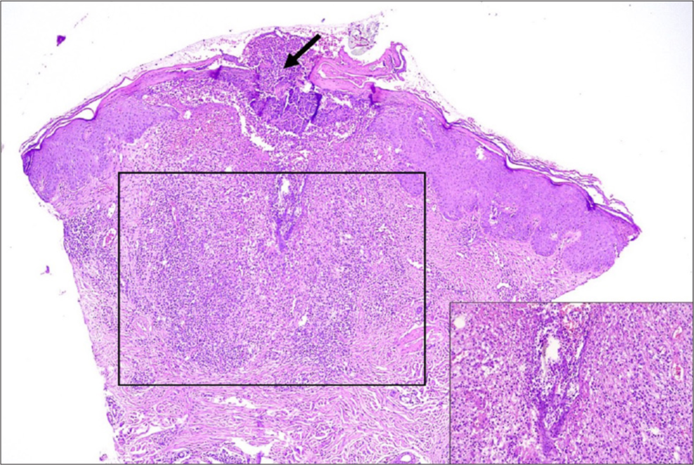 Scalp biopsy showing acanthotic epidermis with neutrophilic exocytosis, foci of parakeratosis, and ulceration covered by a crust composed of fibrin and leukocytes, in continuity with the follicular ostium (arrow). The dermis exhibits a dense mixed inflammatory infiltrate, predominantly neutrophilic, consistent with an abscess surrounding exogenous particulate and filamentous material. Foreign body–type multinucleated giant cells and associated fibrosis are also observed. Inset: filamentous material amid the intense acute inflammatory reaction.
