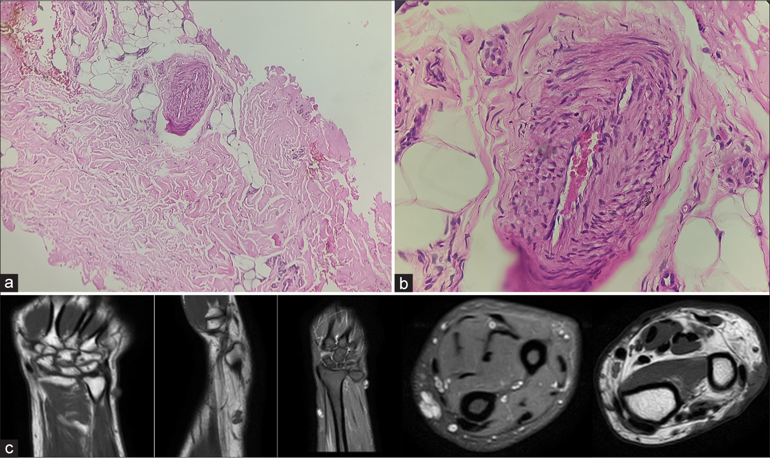 (a) Microscopic section shows a ×100 view of a proliferative vascular lesion shelled out from rest of the dermis (hematoxylin and eosin stain) and (b) microscopic section shows a ×400 view of lumen of the proliferative vessel having papillomatous outline with endothelial hyperplasia (hematoxylin and eosin stain). (c) Multiple magnetic resonance imaging sections demonstrating heterogenous insinuating nodules in the subcutaneous plane along the extensor compartment of distal forearm appearing hyperintense on T1- and T2-weighted images.