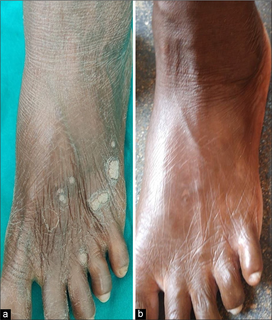 A 50-year-old female with multiple warts over dorsum of left foot (a) before immunotherapy with Candida albicans, and (b) at week 8 after intralesional Candida albicans immunotherapy showing complete clearance of both injected and uninjected warts.