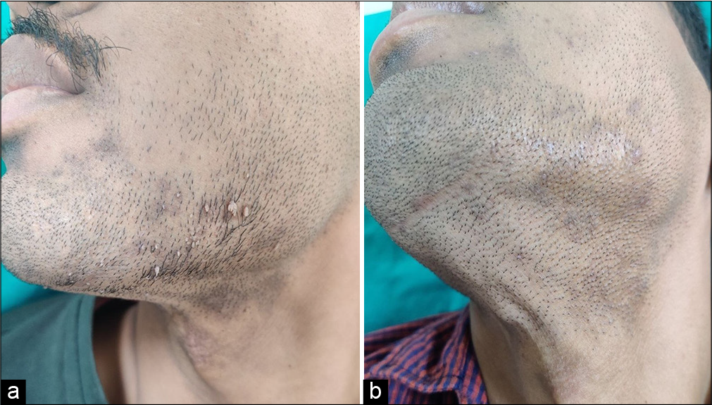 A 27-year-old male with filiform warts over beard area (a) before immunotherapy with MMR, and (b) at week 8 showing complete clearance of both the injected and uninjected warts with intralesional. MMR. MMR: Mumps, measles, rubella.