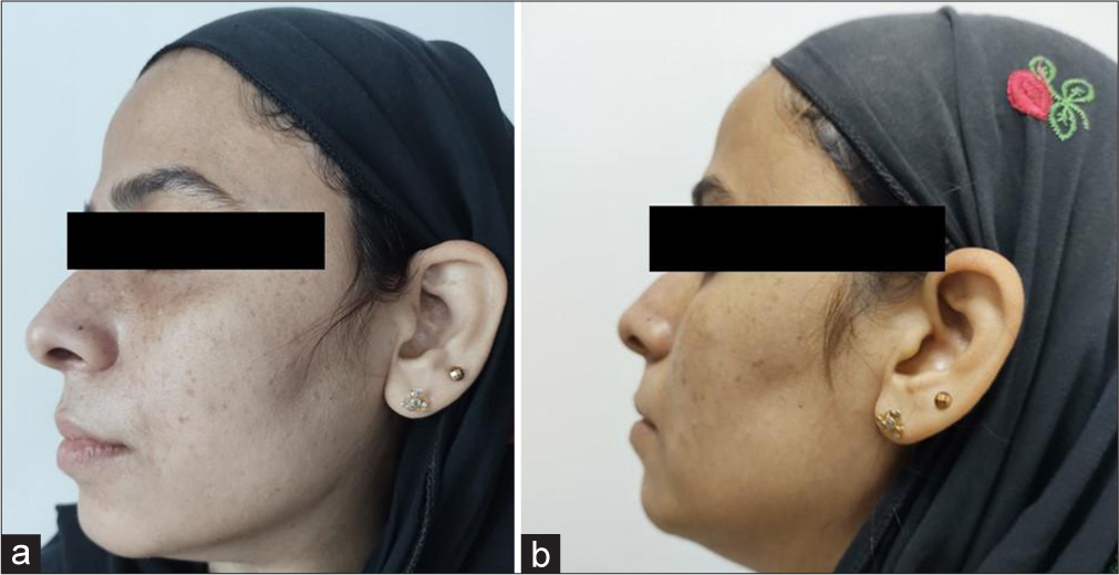 (a) Global photographs of patient 3 at baseline in group A, (b) global photographs of patient 3 at 2 months in group A.