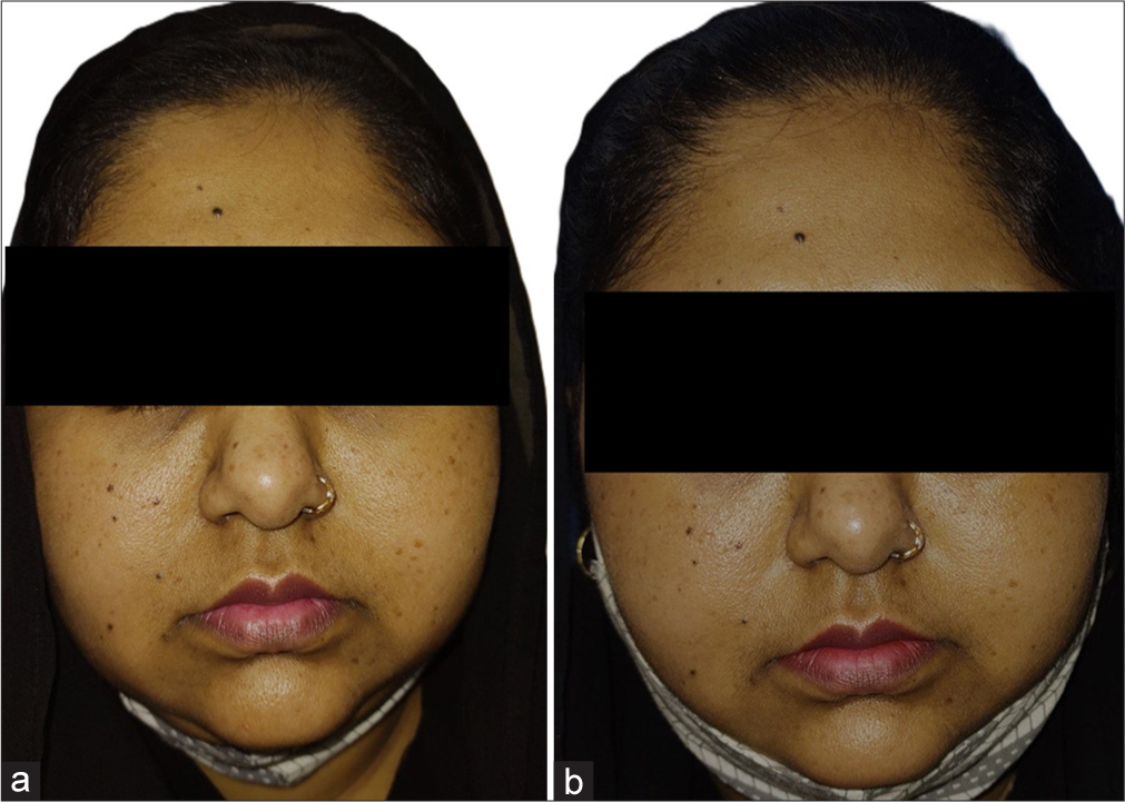 (a) Global photographs of patient 4 at baseline in group A, (b) global photographs of patient 4 at 2 months in group A.