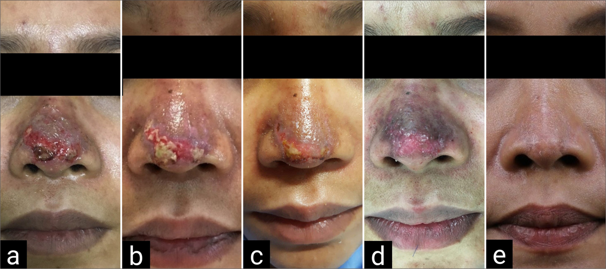 Case 2 dermal loss at tip with the area of yellowish necrotic tissue (a) 7-day post-filler injection (b) 8-day post-filler injection; hyaluronidase was injected (c) 11-day post-filler injection (3 days after hyaluronidase injection) (d) 21-day post-filler injection; lipofilling was done (e) 6 weeks after lipofilling.