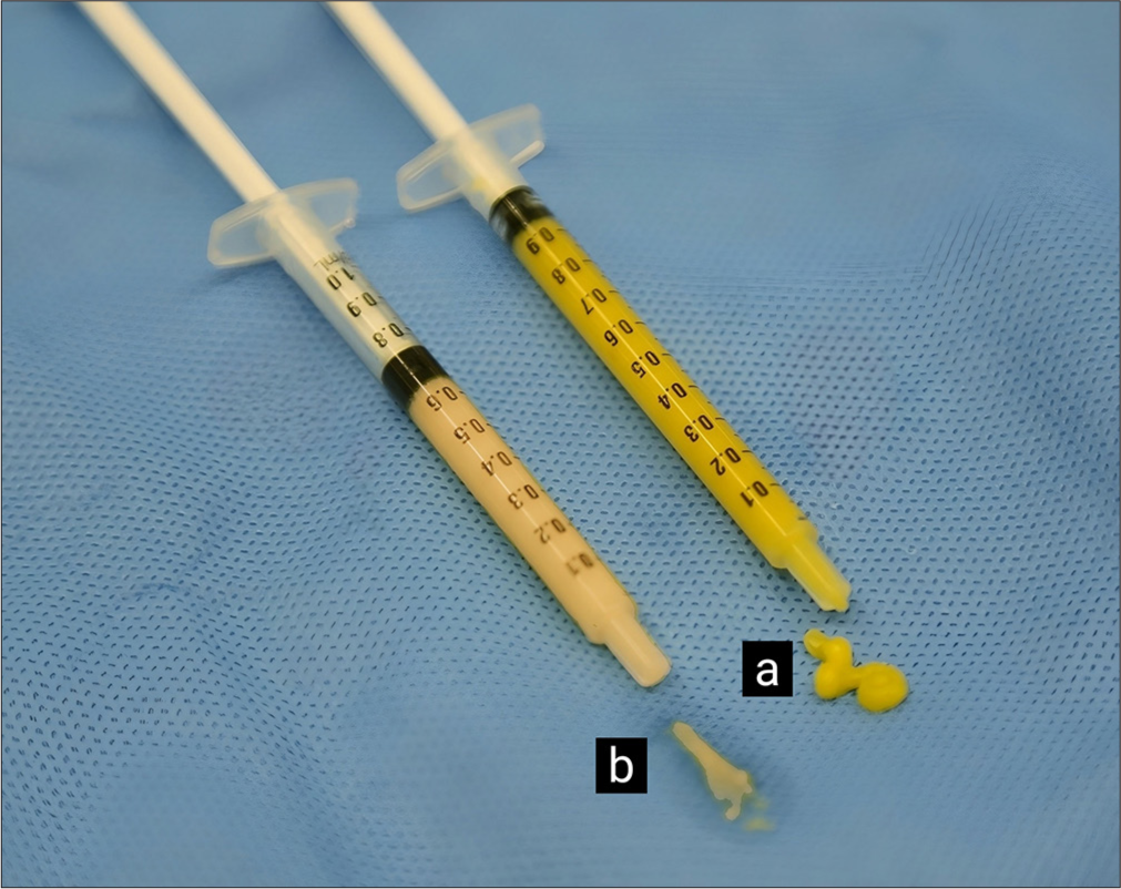 (a) Microfat. (b) Nanofat: More liquid and whitish appearance.