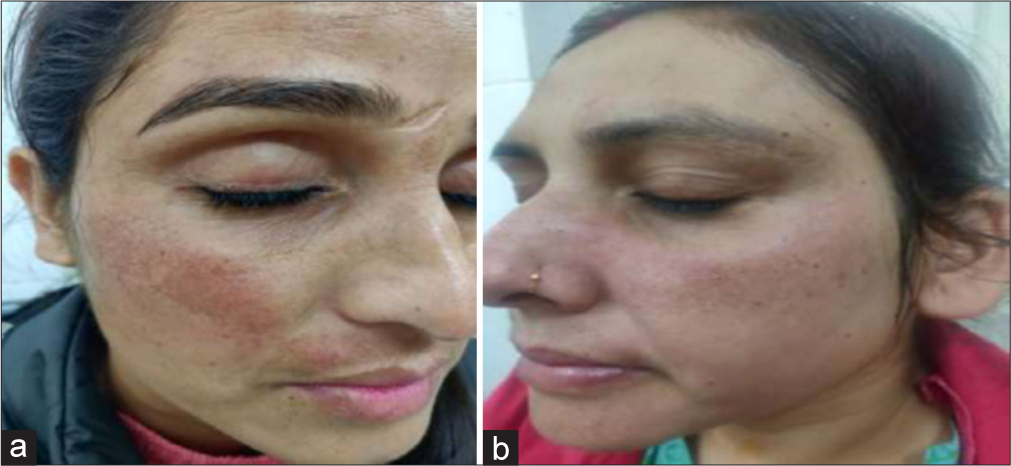 (a) Erythema after Nd:YAG laser therapy. (b) Erythema after glycolic acid (GA) peeling. Nd:YAG: neodymium-doped yttrium aluminium garnet.